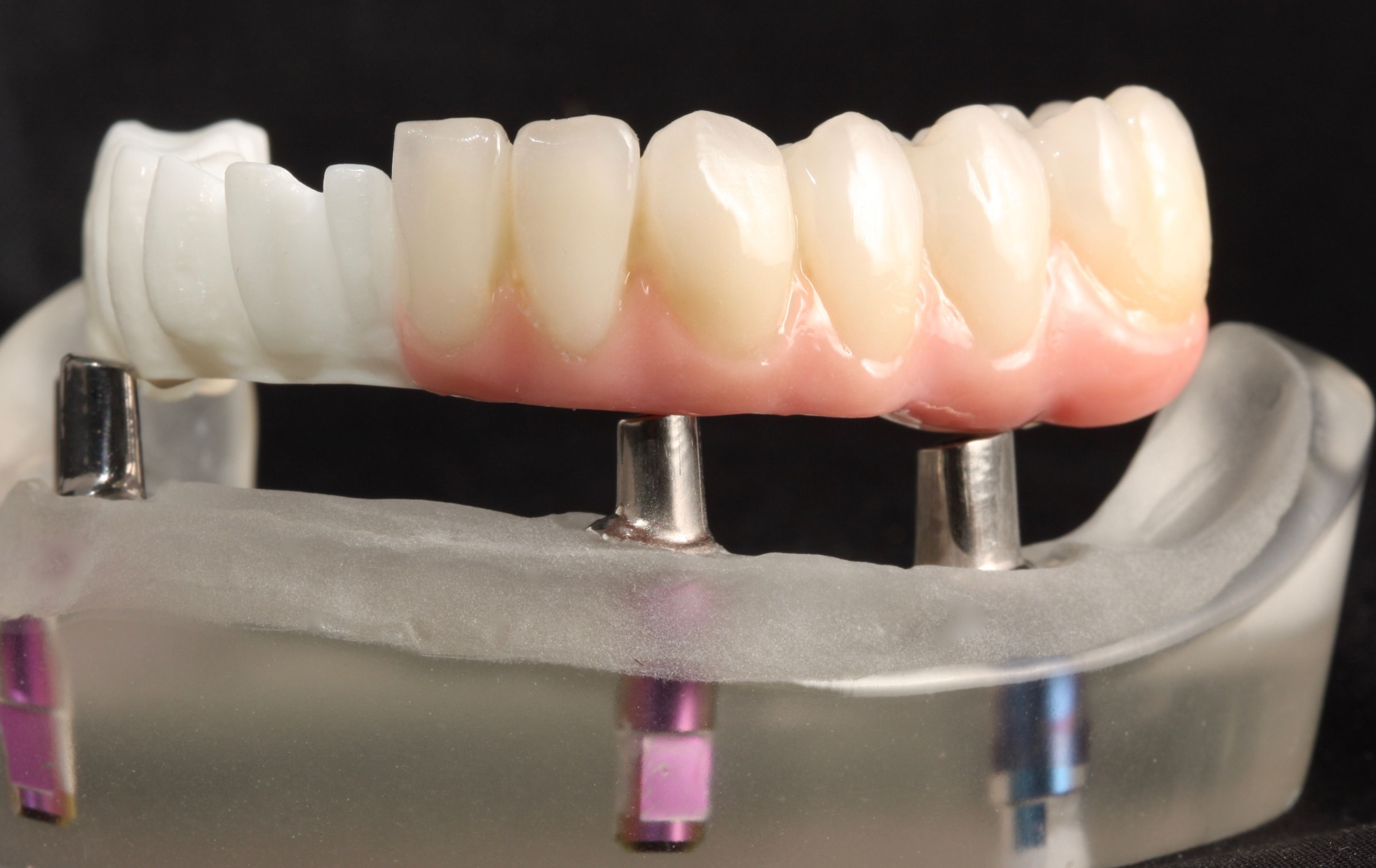 Implantate 1
